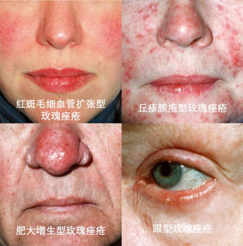 肌底平衡术-玫瑰痤疮_2.png